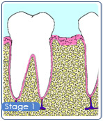 Stages of Restoring Missing Teeth - Dental Bridges by Dr. Sih and His Team of Dental Professionals in Bondi, Sydney
